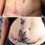 Tetovažama protiv ožiljaka i belega