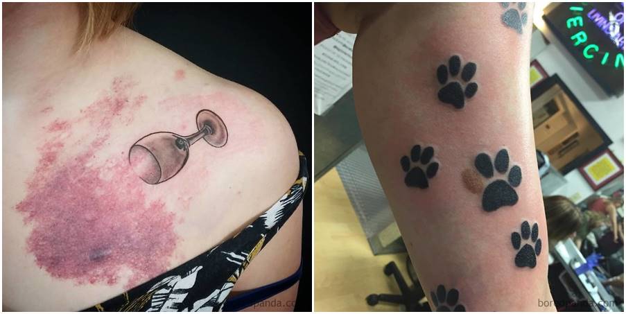 Tetovažama protiv ožiljaka i belega