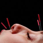 Da li akupunktura lica predstavlja novi botoks?