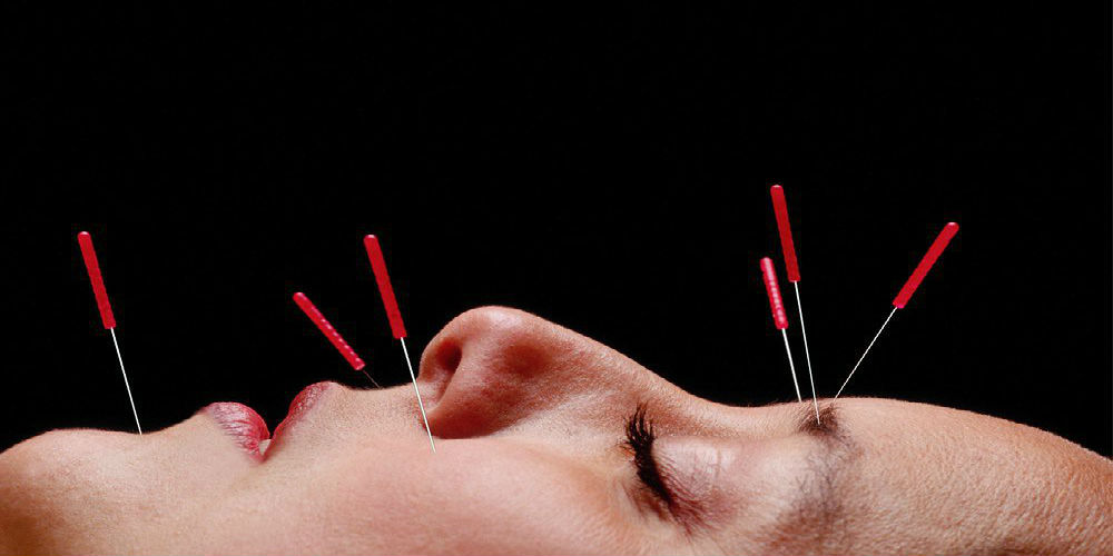 Da li akupunktura lica predstavlja novi botoks?