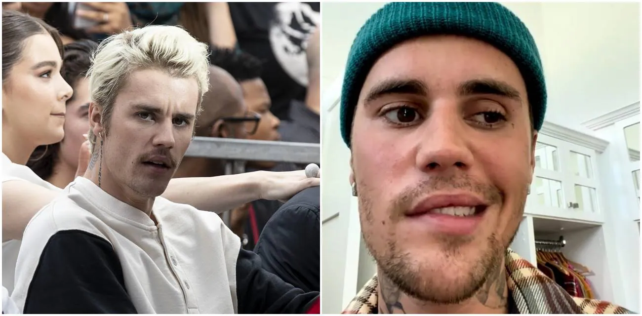 Sve što treba da znate o Remzi Hantovom sindromu koji je paralisao lice Džastina Bibera