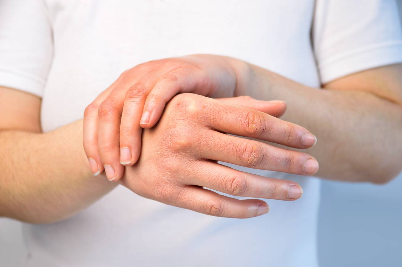 Kako sprečiti da koža na rukama bude suva zimi? Koristite ove trikove