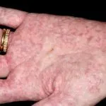Izgleda kao da imate vučije ugrize na šakama: Šta je lupus i kako se leči?