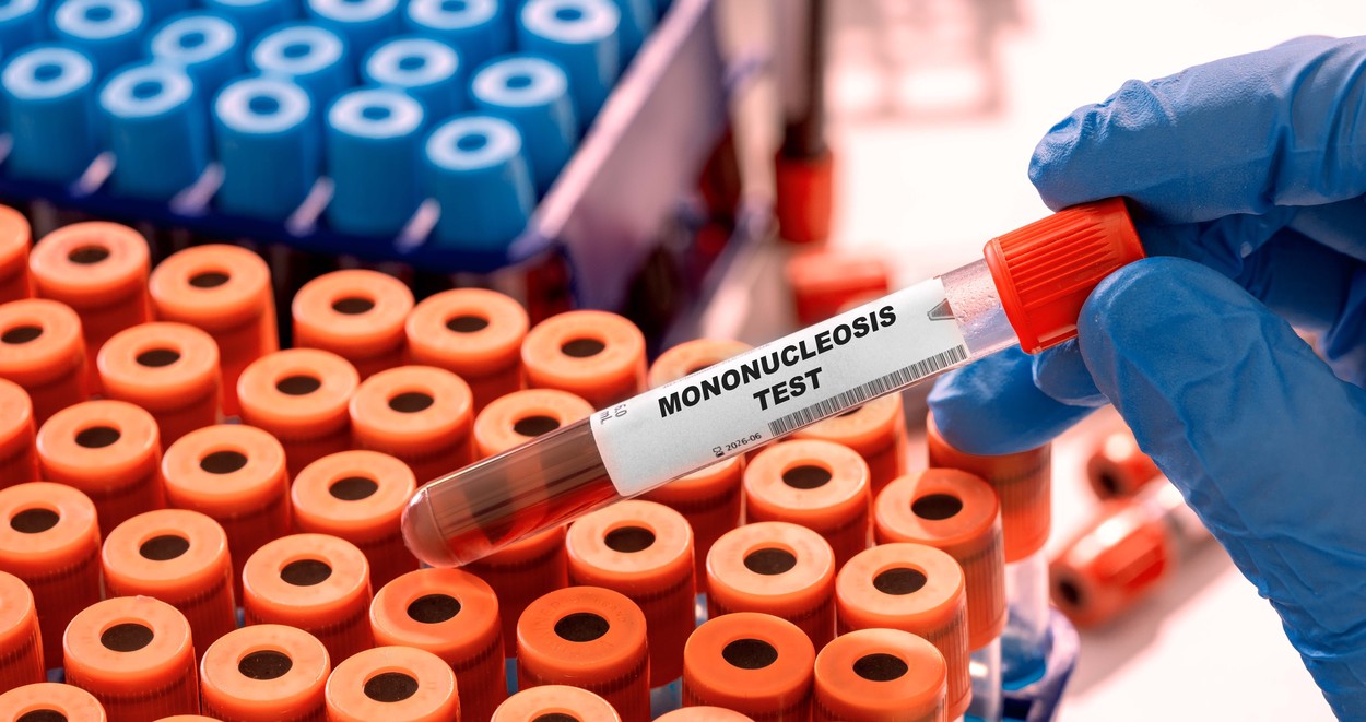 Šta je mononukleoza: Prvi simptomi javljaju se već posle četvrtog dana od zaraze